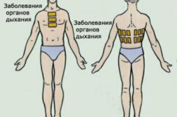 Места наложения горчичников при насморке