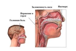 Симптомы гайморита