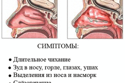 Аллергический ринит как причина заложенности носа