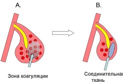 Схема лазерной коагуляции для лечения ринита