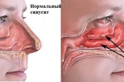 Схема ринита