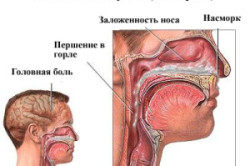 Симптомы гайморита