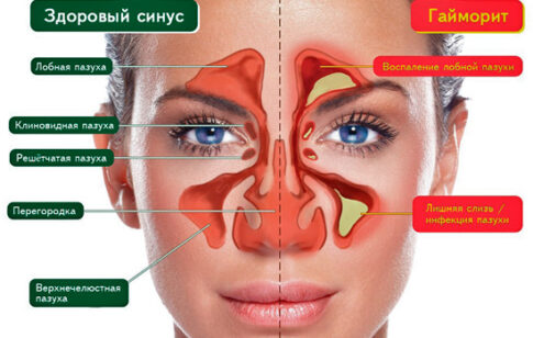 Почему болит нос при рините (насморке)
