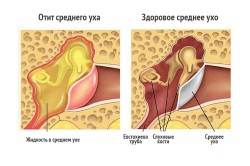 Отит