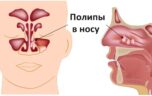 Узнайте что такое гайморит и чем он опасен для здоровья человека