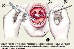 Принцип задней риноскопии