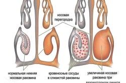 Схема ринита