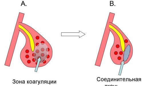 Метод лечения ринита лазером