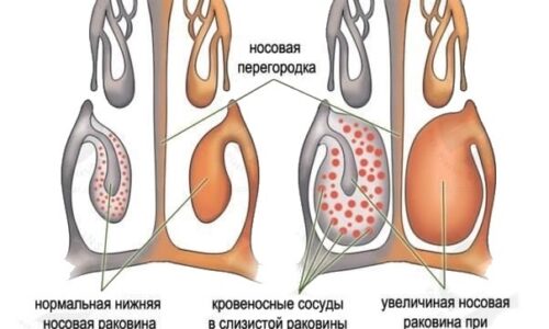 Какие капли в нос следует использовать при аллергическом рините?